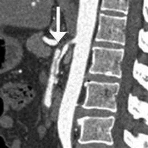 Sagittal Slab Maximum Intensity Projection Images Of The Thoracic Aorta