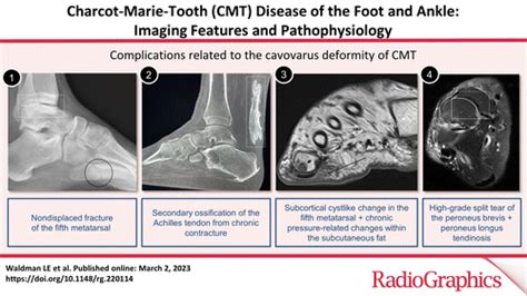 Charcot Marie Tooth Disease Of The Foot And Ankle Imaging Features And Pathophysiology