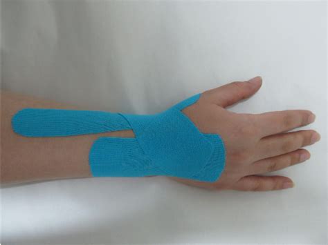 Figure 1 From Comparison Between Kinesio Taping And Physiotherapy In