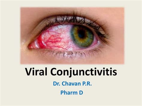 Viral Conjunctivitis Basic Overview Ppt