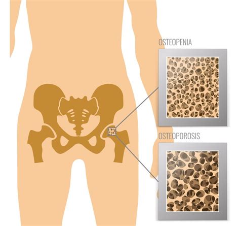 Sabes qué es la osteopenia OseaMx