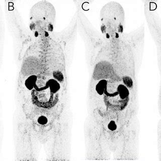 PSMA Imaging Before And After Targeted Radioligand Therapy With 177