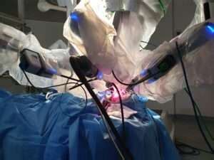 Thyroidectomy Using Robot In India Macs Clinic