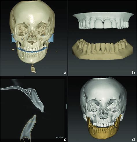 Overview Of The Fusion Process In The Ips Casedesigner A