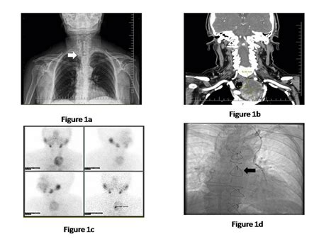 A Preoperative Chest X Ray White Arrow Showing The Tracheal