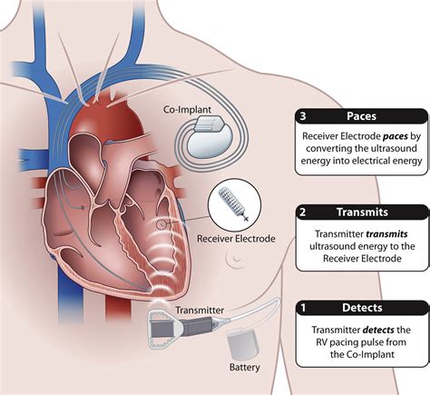 Real World Experience Of Leadless Left Ventricular Endocardial Cardiac