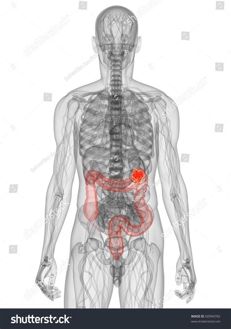 Colon Cancer Stock Photo 60994765 : Shutterstock