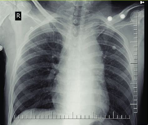 Antero Posterior Chest Radiograph The Axial Sections Of Thoracic