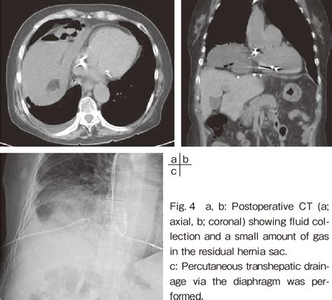 Figure From A Case Of Laparoscopic Repair Of Morgagni Hernia That