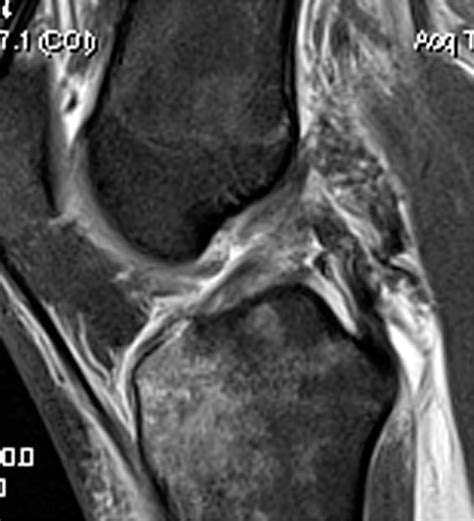 Figure From Arthroscopic Primary Repair Of Posterior Cruciate