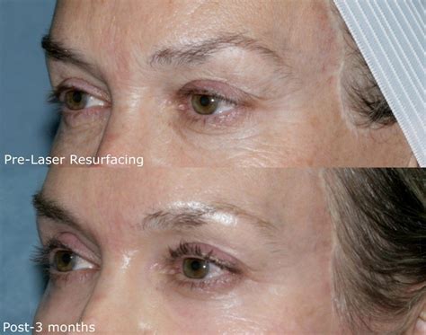 Affirm Multiplex Laser Resurfacing San Diego Ca Clderm