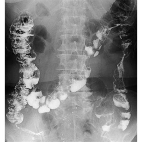 Colonic Diverticular Bleeding In The Hepatic Flexure On Colonoscopy