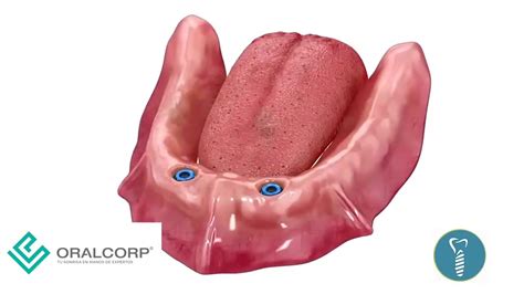 Implante Unitario Puente Sobredentadura Youtube