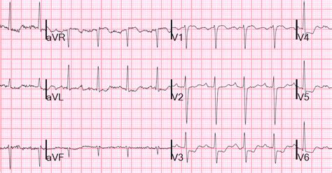 Dr Smiths Ecg Blog What Is The Treatment For This Subendocardial