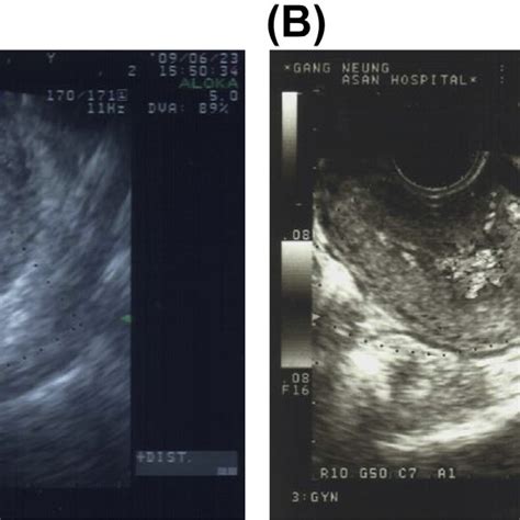 A Transvaginal Gray Scale Ultrasound Image Showing An Anechoic Area