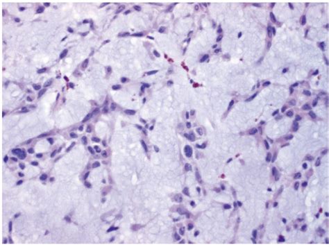 Extraskeletal Myxoid Chondrosarcoma Presenting As A Plantar Fibroma