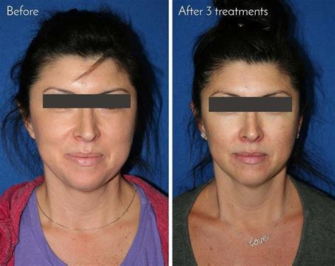 HIFU Before And After (4) » Facelift: Info, Prices, Photos, Reviews, Q&A