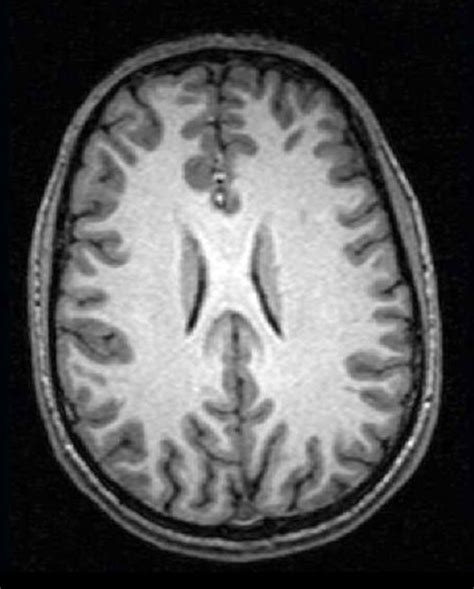 body of corpus callosum mri Diagram | Quizlet