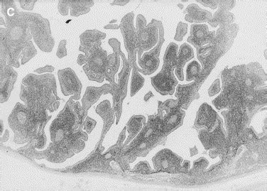 MR Imaging Findings Of Parotid Tumors With Pathologic Diagnostic Clues