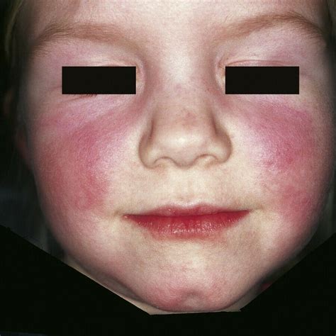 Erythema Infectiosum Fifth Disease Medizzy