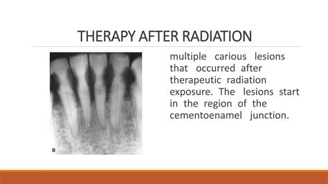 Radiographic Of Interpretation Of Dental Caries Ppt