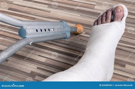 Broken Ankle In Gypsum Stock Photo Image Of Fracture