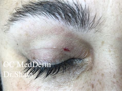 Eyelid Bumps Surgeries Cosmetic Dermatology Irvine And Orange County