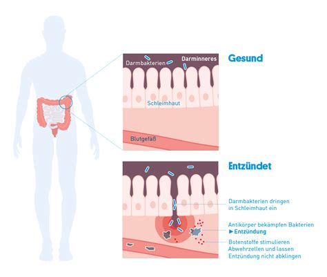 Colitis Ulcerosa Mein Leben Mit CED