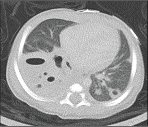 Necrotizing Pneumonia