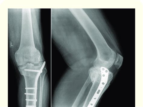 A And 5b Case 2 Preoperative Anteroposterior Ap And Lateral Radiograph Download Scientific