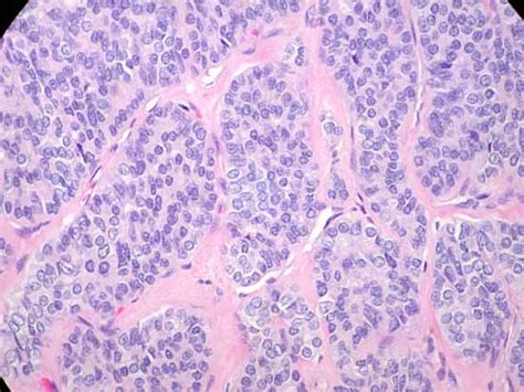 poorly differentiated carcinoma pathology