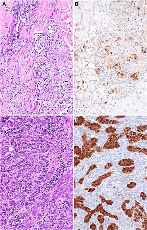 Testicular Neoplasms With Sex Cord And Stromal Components Harbor A