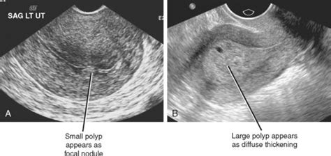 Female Reproductive System Ultrassom