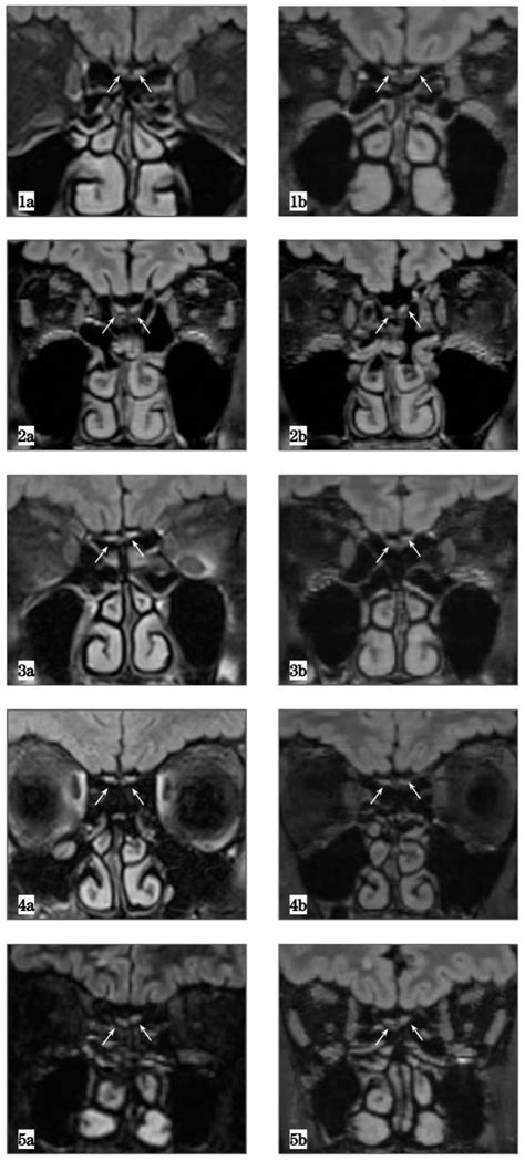 Olfactory Nerve Mri