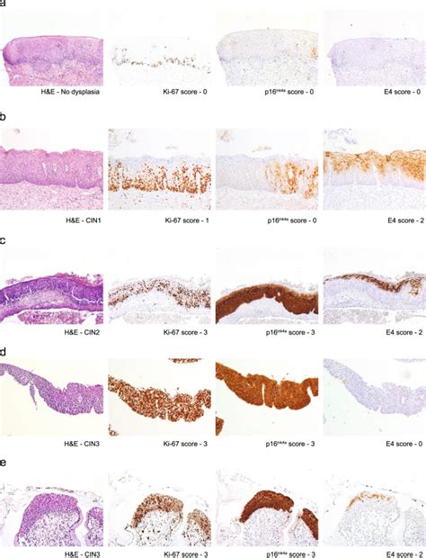 Hpv E Expression And Dna Hypermethylation Of Cadm Mal And Mir