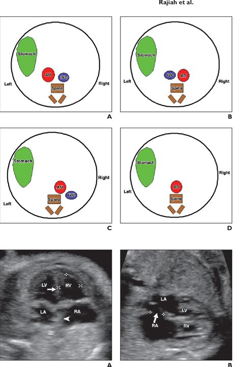 Figure 4 From Ultrasound Of Fetal Cardiac Anomalies Semantic Scholar