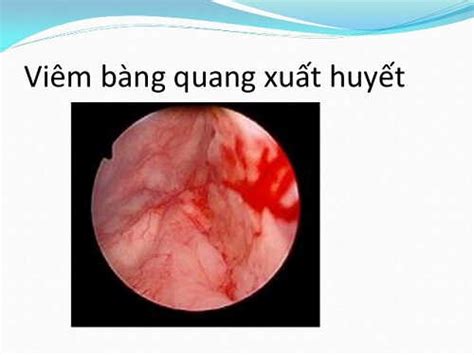 Viêm Bàng Quang Xuất Huyết Và Cách điều Trị Triệt để