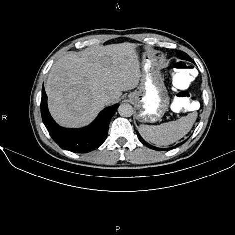 Metastatic Sigmoid Colon Cancer Image