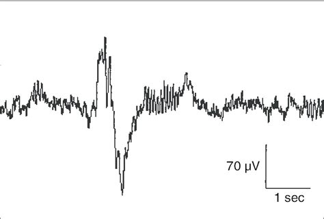 Typical K-complex with subsequent sleep spindle. | Download Scientific ...