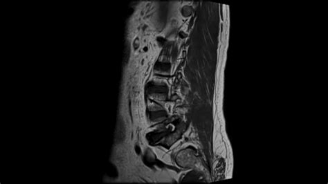 MRI of the lower back, medical analysis of the back, spine 21792228 ...