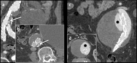 Type Iiia Endoleak A Coronal And B Axial Images Show Contrast Medium