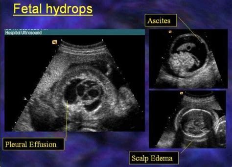 hydrops fetalis fetus ultrasound school ultrasound sonography