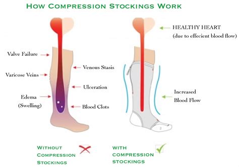 Compression Stockings - Brampton Foot Clinic