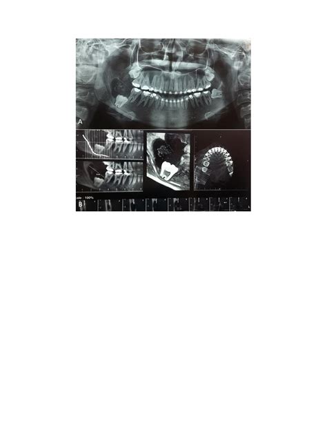 (PDF) Developing odontoma arising from Calcifying odontogenic cyst: a ...