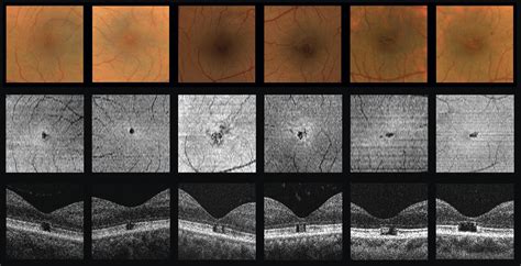 High Resolution Optical Coherence Tomography Findings In Solar