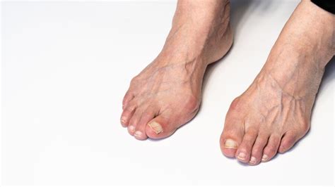 Hallux Valgus Causas S Ntomas Y Tratamientos Copalmech