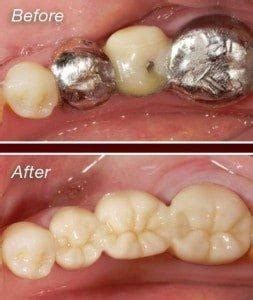 Zirconium-Crown-Before-and-After-253×300 | Partners in Dental Health