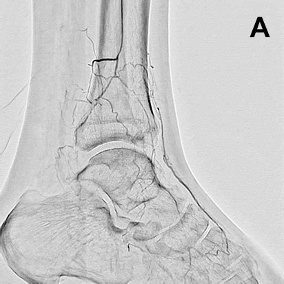 下肢血管腔内治疗方面最大限度地运用Trinias的应用程序 用户体验 Minimally Invasive Experience 岛津医疗