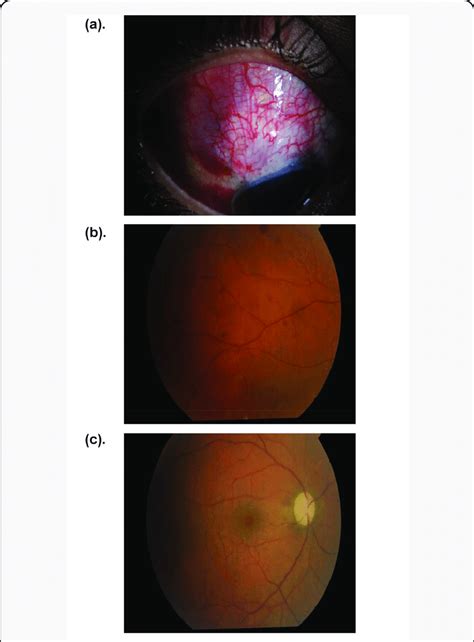 Showing A Slit Lamp Anterior Segment And B Retinal Photographs 1