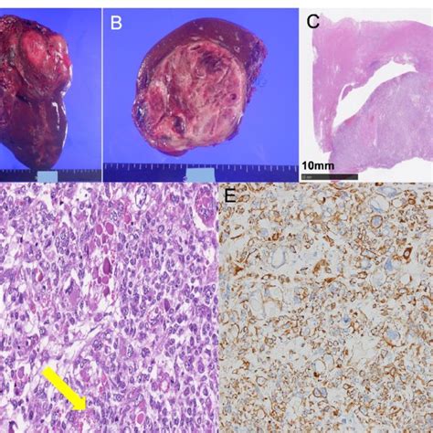 Postoperative Specimen Findings A B Macroscopic Findings Of The